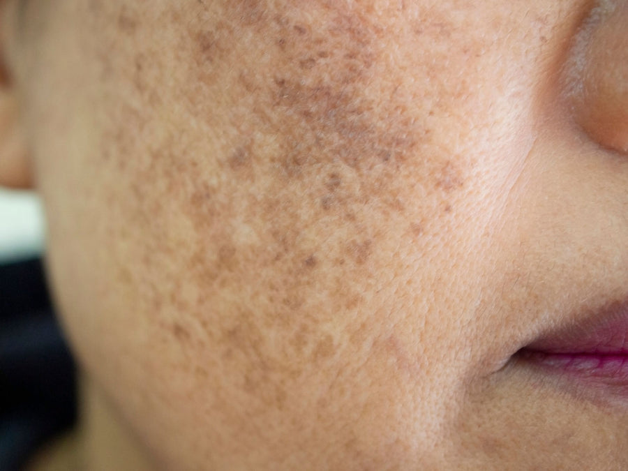 Je behandelt melasma alsof het een zonvlek is