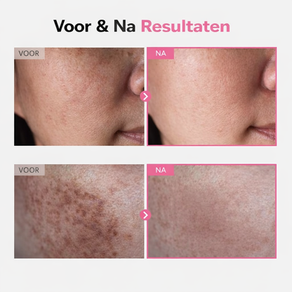 Arbutin 7% + Tranexamic Acid 4% Cream