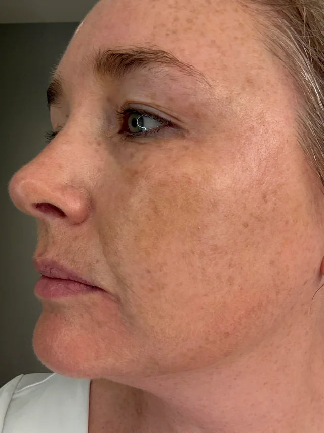 5 redenen waarom jouw melasma niet weggaat